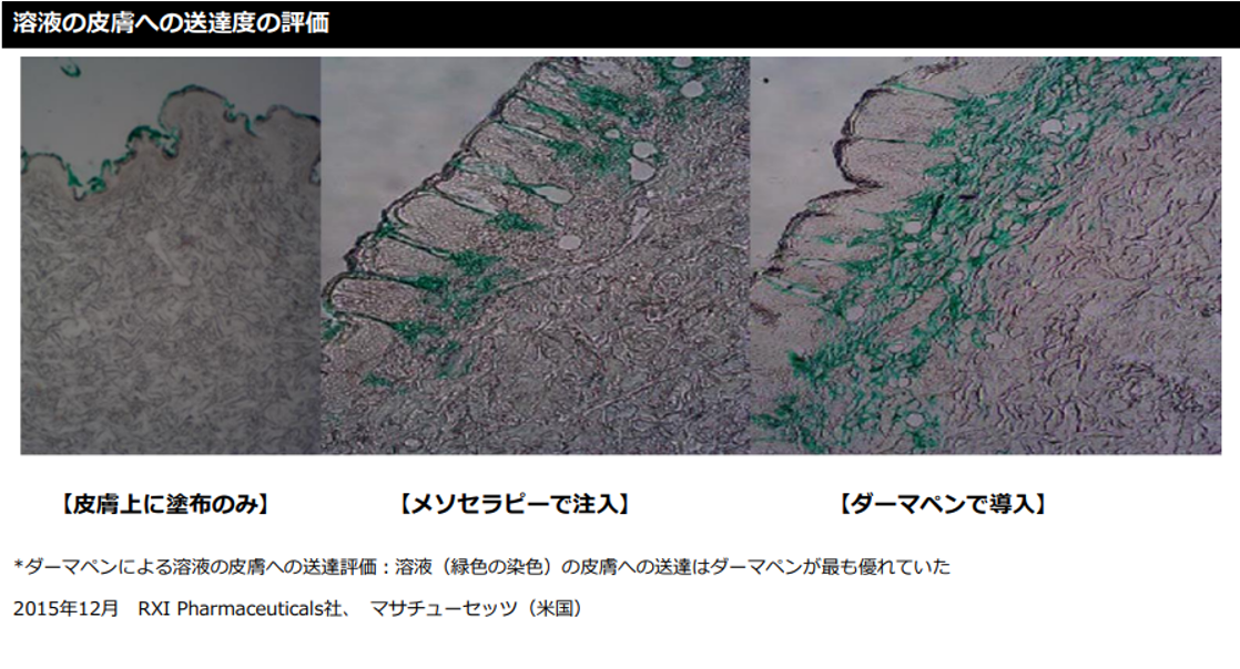 ダーマペン | 幕張まーるクリニック 皮フ科形成外科 | 幕張駅・京成幕張駅・検見川駅 | 美容皮膚科 美容外科